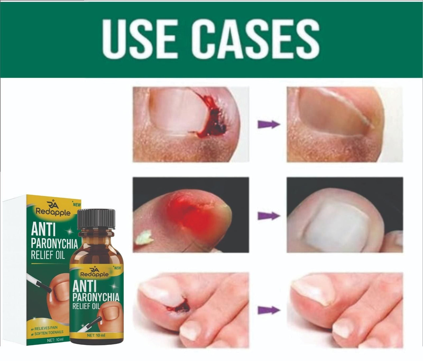 All-In-One Nail Repair & Anti-Paronychia Relief Oil (Buy 1 Get 1 Free)