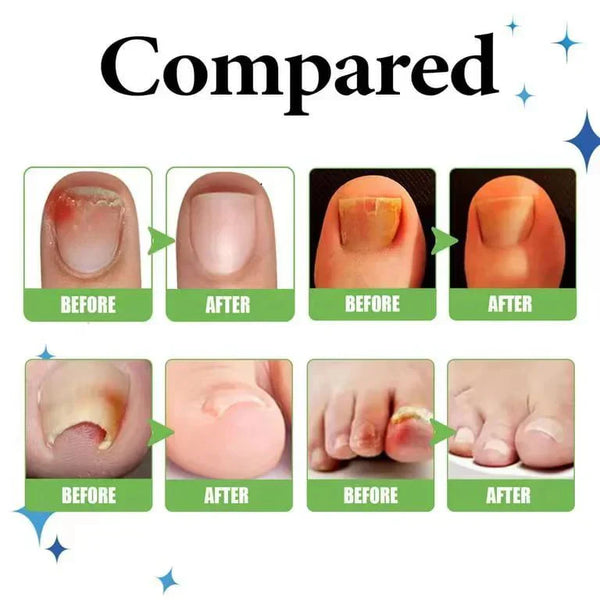 All-In-One Nail Repair & Anti-Paronychia Relief Oil (Buy 1 Get 1 Free)