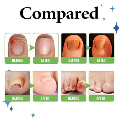 All-In-One Nail Repair & Anti-Paronychia Relief Oil (Buy 1 Get 1 Free)