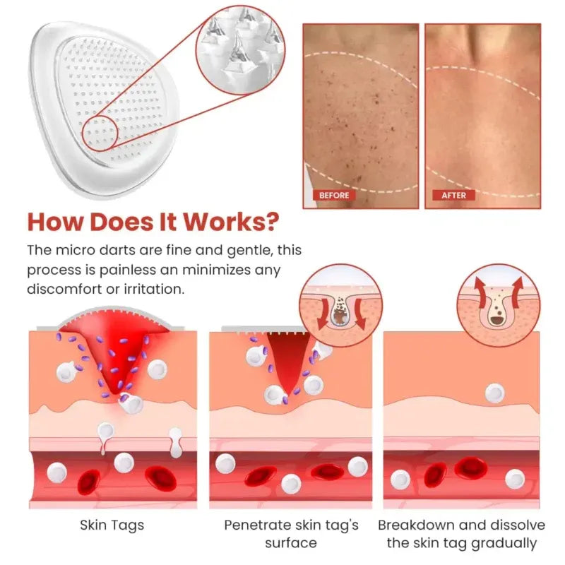 Derma Smooth Skin Tag Removal Patch | Secret to Spotless Skin ✨ (Pack Of 36)