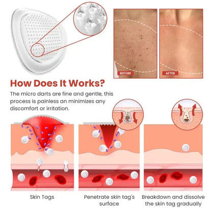 Derma Smooth Skin Tag Removal Patch | Secret to Spotless Skin ✨ (Pack Of 36)